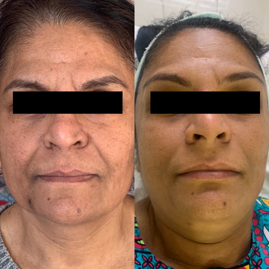 Microneedling before and after on a client in Sutton: more even skin tone across the cheeks with pigmentation and sun marks lifted