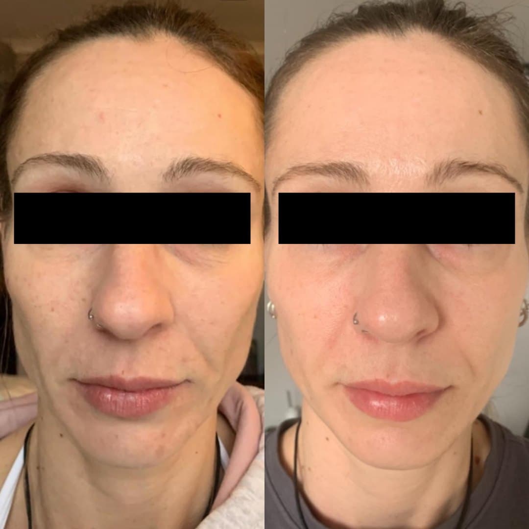 Microneedling before and after on a client in Sutton: smoother skin texture on the cheeks and jaw, with fewer blemishes and marks